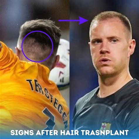 Ter Stegen Hair Transplant l Before and After