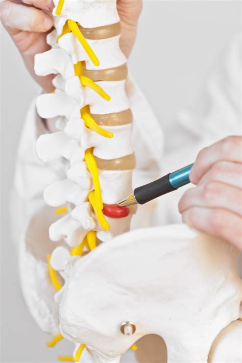 Herniated Disc Alamo Neurosurgical Institute