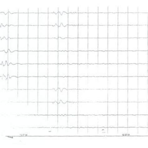 -EEG performed some hours after birth. Note that it is isoelectric ...