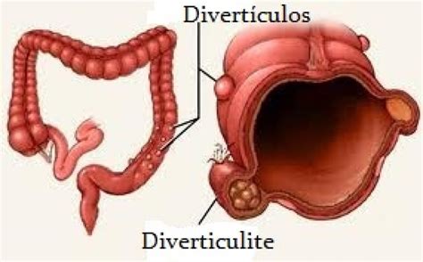 Diverticulose X Diverticulite Clínica Do Aparelho Digestivo