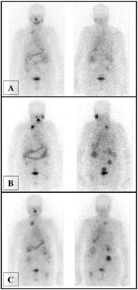 131 I Whole Body Scans Left Anterior Right Posterior Scan Before