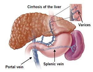 Esophageal Varices Causes & Treatment | Cleveland Clinic