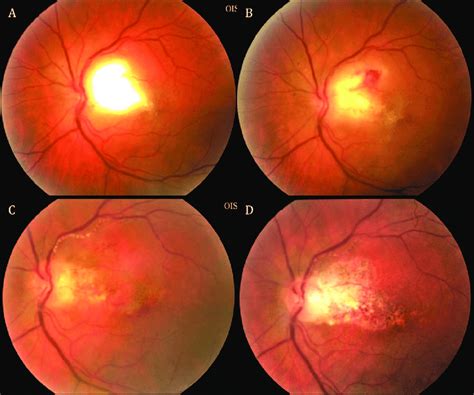 Active Toxoplasmic Retinochoroiditis Involving Zone In An