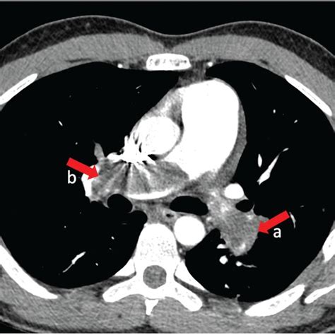 Computed Tomography Angiography Of The Pulmonary Artery After Surgical