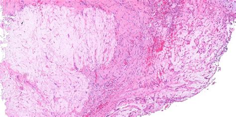 Pathology Outlines Nephrogenic Metaplasia