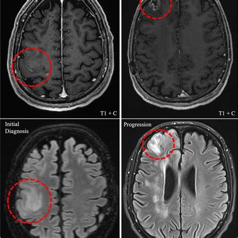 Mri Of The Cns Axis From Case Left Mri Of The Brain With And