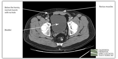 Recent Case Highlights California Hernia Specialists