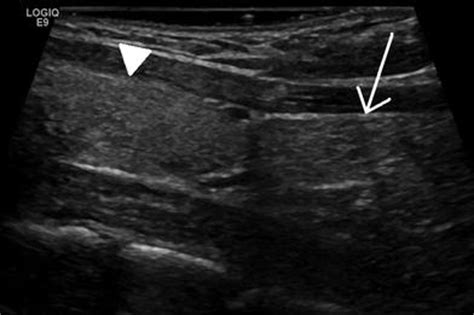 Of The Pediatric Thymus And Thymic Disorders Radiology Key