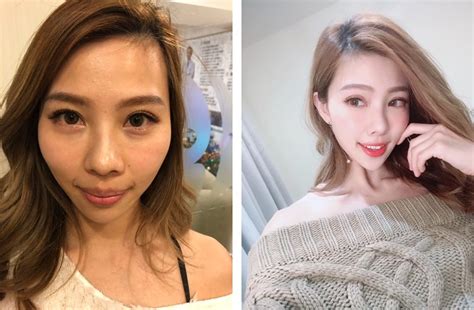 台中醫美診所微整形拯救下巴、眼角魚尾紋》肉毒、玻尿酸心得分享～ Beautytoday美麗線上‧台灣