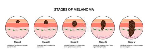 The Stage III Melanoma Tumors Stock Illustration - Illustration of dermis, hypodermis: 281922542