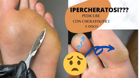 PEDICURE IPERCHERATOSI Cos E E Come Rimuoverla YouTube