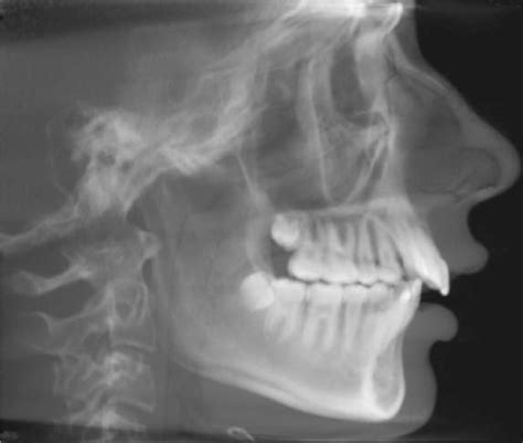 Non Surgical Treatment Of A Late Adolescent Patient With Skeletal Class Ii Malocclusion Using