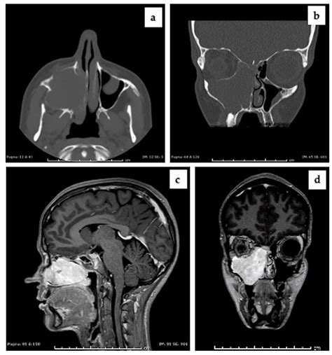 Nasal Polyp Mri