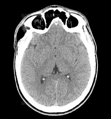 Congenital Dermoid Cyst Ct Scan Stock Image Science Source Images