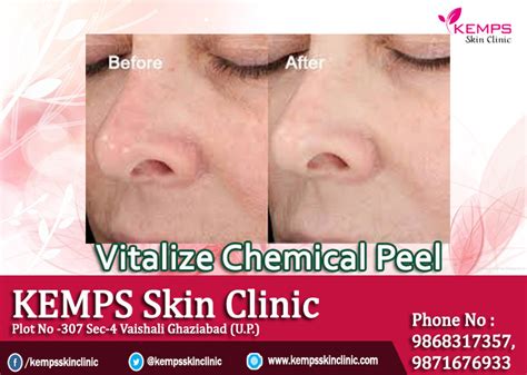 Vitalize Chemical Peel Help To Reduce Signs Of Aging Kemps Skin Clinic