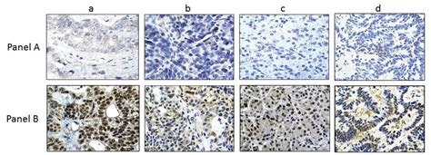 CARM1 Expression In BRG1 Negative Tumors In Panel A 4 Representative