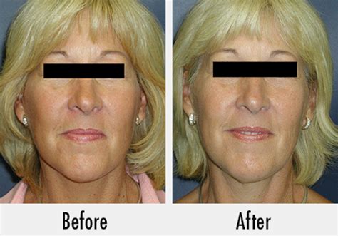 Top Facelift Plastic Surgeon in Detroit | Dr. Ali - Dr Ali