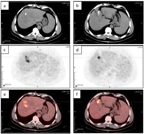 Years Old Male Patient With Hcc Underwent Tace Of The Hepatic Focal