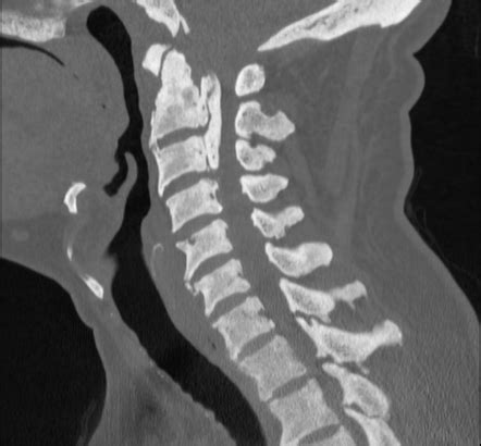 Playlist Spine Bone Marrow Disease By Dr Mohamed Saber