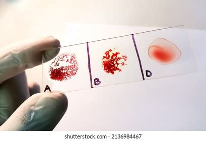 Ab Negative Rare Blood Group Testing Stock Photo 2136984467 | Shutterstock