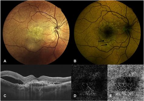 Right Eye Of A 78 Year Old Female Patient With Active MNV Secondary To