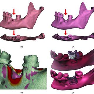 Following Tooth Extraction The Alveolar Ridge Undergoes An Inevitable