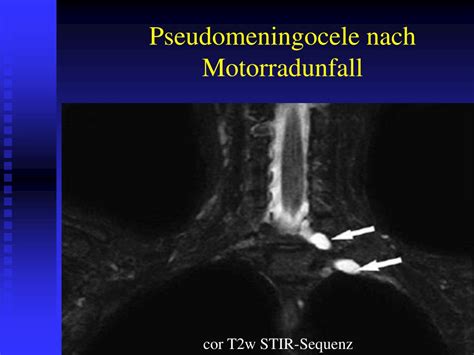 PPT MRT bei Plexus brachialis Läsionen PowerPoint Presentation free