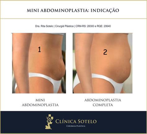 Abdominoplastia E Mini Abdominoplastia Qual A Diferen A Lajeado Rs