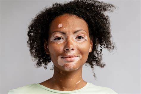 Vitiligo | Reno Tahoe Dermatology | Best Reno Dermatologist