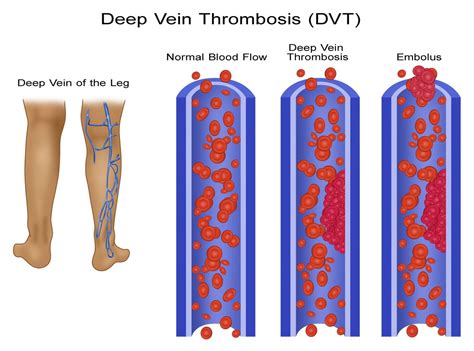 Leg Blood Clots Poster Print By Gwen Shockey Science Source X