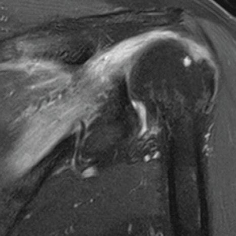 Axial T2 MRI Of The Left Shoulder Demonstrating Hyperintensity