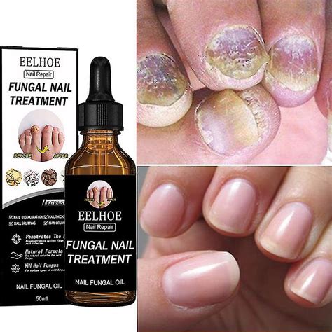 Days Remove Onychomycosis Eelhoe Nail Repair Treatment Cream Ml