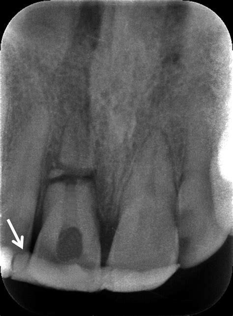 Treatment Of Horizontal Root Fractures Using A Triple Antibiotic Paste And Mineral Trioxide