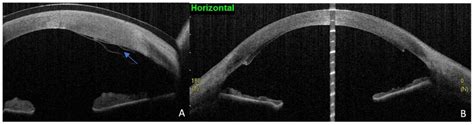 Diagnostics Free Full Text Role Of As Oct In Managing Corneal Disorders