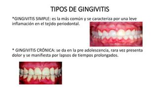 La GINGIVITIS 091955 Pptx