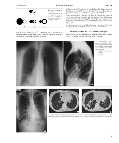 Syndrome Bronchique