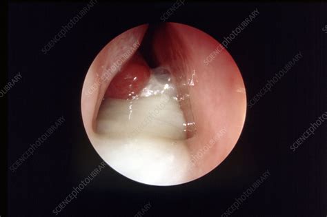 Nasal Mucus In Sinusitis Rhinoscope View Stock Image M260 0402 Science