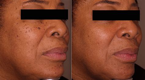 Dpn Before After Dermatology Laser And Vein Specialists Of The Carolinas