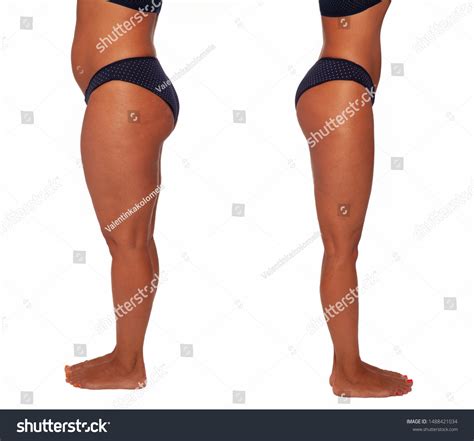 3,702 Cellulitis Leg Images, Stock Photos & Vectors | Shutterstock