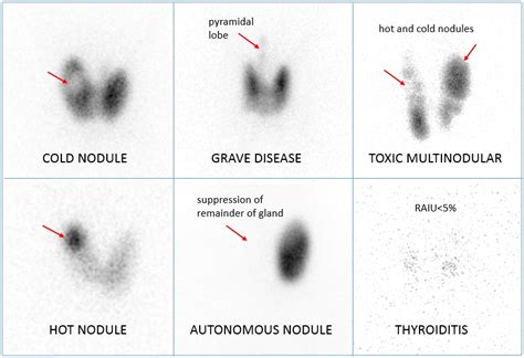 My Notes For Usmle — Thyroid Hormone Disorders Raiu Radioactive Iodine