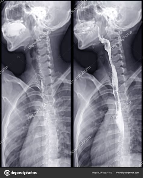 Barium Swallow Study Test Diagnose Barretts Tract Exam Gerd Ulcers