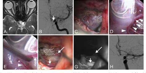 Figure 1 From Is It Safe To Sacrifice The Superior Hypophyseal Artery