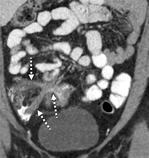 Small Bowel Crohn Disease At Ct And Mr Enterography Imaging Atlas And Glossary Of Terms