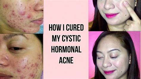 How I Cured My Cystic Hormonal Acne Youtube