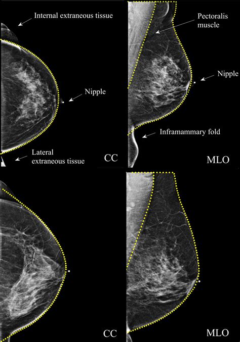 Mlo Mammography Positioning