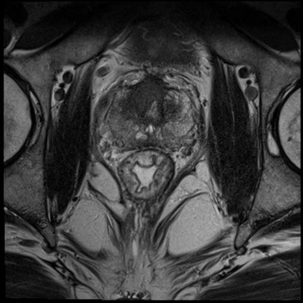 Prostate Imaging Reporting And Data System PI RADS Radiology