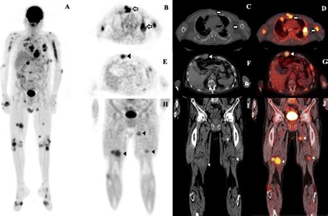 A Mip Image Shows Multiple Soft Tissue Masses With High Fdg Uptake And Download Scientific