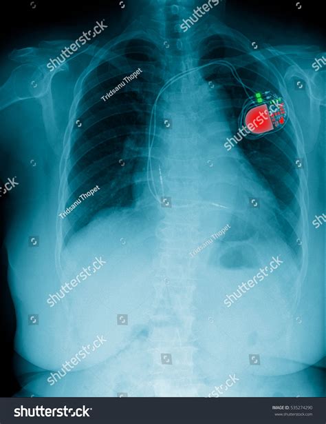 Chest X Ray Show Pacemaker Cell Stock Photo Shutterstock