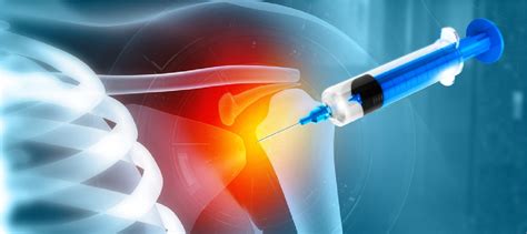 Shoulder Arthroscopy Recovery Time: What to Expect and How Long It ...