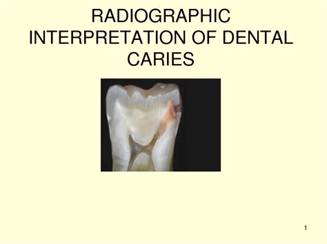 Solution Radiographic Interpretation Of Dental Caries Bds Lecture